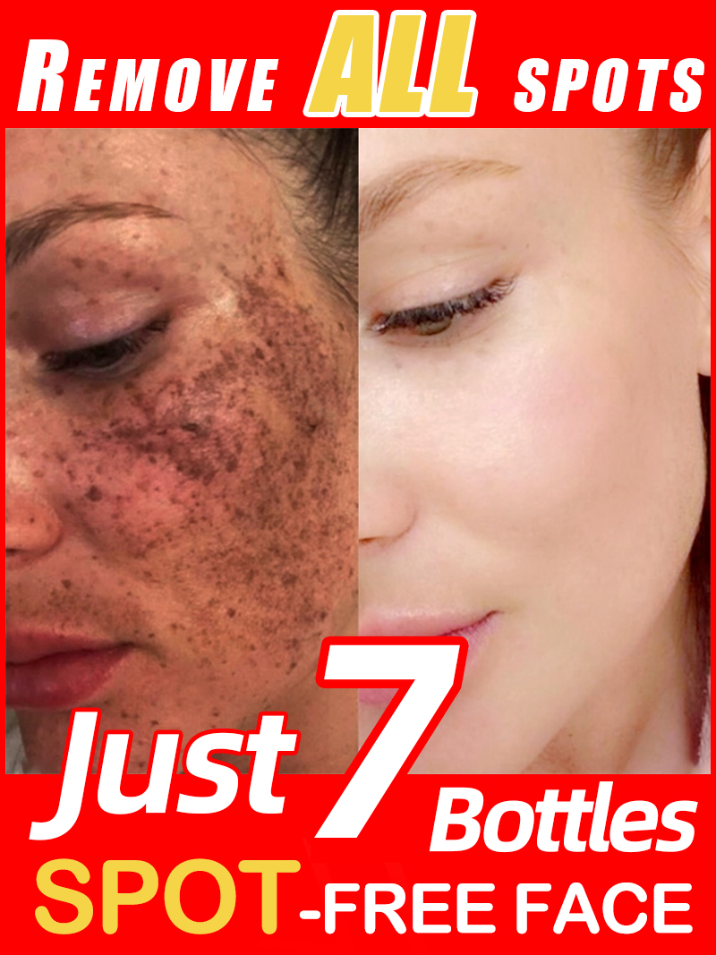 Lighten Freckles Melasma, Faci - Skincare Luxury Whitening review and price